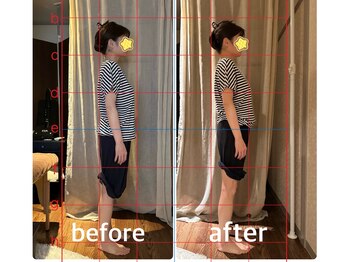 スイレン 西新宿(SUIREN)/施術1回でのbefore/after