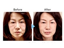 リフトユーアップ(Lift You Up)の雰囲気（たるみの原因は表情筋の衰えです。トレーニングで5年前の表情に）