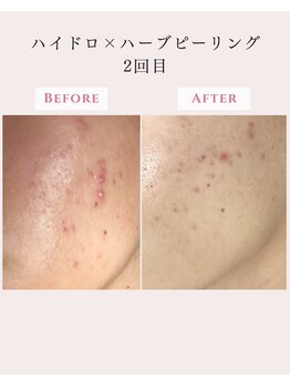 レクラ バイ ドクターエイチ(L'ECLAT by Doctor.H)/ハイドロ×ハーブピーリング