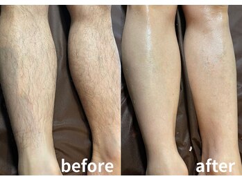 メンズアルファ/匠道ワックス脚脱毛