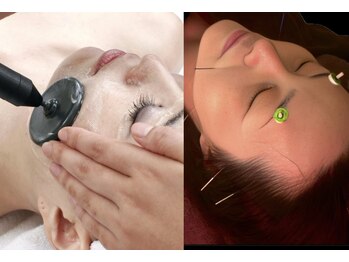 フィットジユウガオカ(Fit_Jiyugaoka)/小顔＆たるみケア鍼＆インディバ