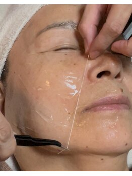 ルーナ(Luna)/【アークスレッド糸リフト】