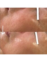 マイン イオンモール浜松市野店/毛穴リメイク＆高濃度水素洗浄