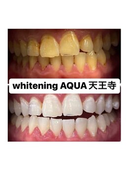 アクア 天王寺店(AQUA)/セルフホワイトニング効果