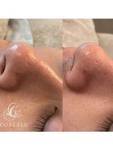 コアラル 恵比寿(COALALU)/【毛穴洗浄】黒ずみ・毛穴ケア