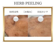 ロージー(ROSY)/ハーブピーリング/阿南/徳島