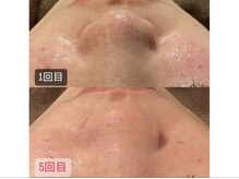 ハイコガオ 中崎町店(HIKOGAO)/全顔ハイドラ×プラズマ