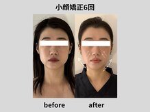 ビトリア 横浜店(BITORIA)/本格小顔矯正