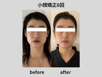 ビトリア 横浜店(BITORIA)/本格小顔矯正