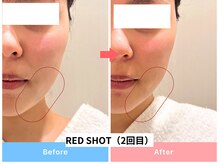 エトワール(etoile)/RED SHOT2回目の効果