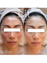 リノージュ(Linoju)/臍帯・羊膜由来幹細胞導入