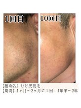エース 赤坂/髭脱毛の症例写真