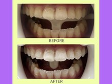 ココティ ホワイトニング(Cocotii)/ビフォーアフター