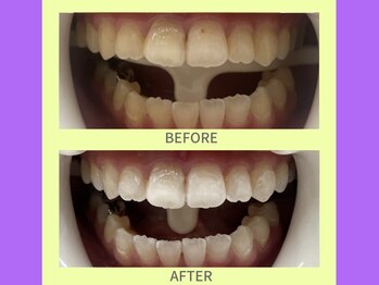 ココティ ホワイトニング(Cocotii)/ビフォーアフター