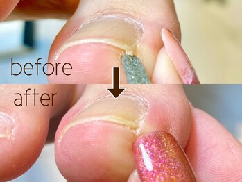 レヴィア(Revia)/巻き爪ケア