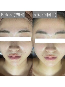 ホワイトアクア 鳳店(WHITE AQUA)/ハーブピーリング 4回目