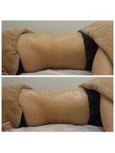 セレア(CELEA)/腸揉み/腸マッサージ/お腹凹み