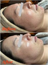 ティアーナ(Tiaana)/ララピール施術直後