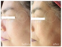 ラミーユ(La Miu)/しみ改善/ハーブピーリング