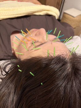 ラフ ネイルアンドモア(Laugh nail&more)の写真/【美容鍼で美顔革命】顔の血行を促進することで、小顔効果とリフトアップを実現◎理想のフェイスラインへ♪