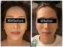 キュープ 福岡天神店(Qpu)/通常コース４回での変化