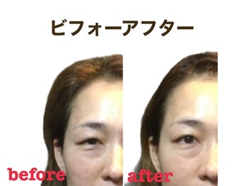 ミクロスポーツ整骨院(MICRO SPORTS整骨院)/【befor/after】40代〔たるみ〕