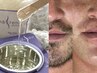 【男性】メンズ髭ワックス脱毛/青髭対策・清潔感UP・快適ツルスベ肌へ