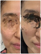 スグァン(sugwang)/ダイヤモンドピーリング