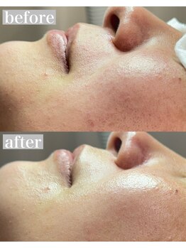 ライカブルー(RaicA BluE)/施術写真　before-after