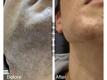 CDF 赤坂/メンズヒゲ脱毛15回目初回￥1000