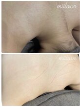 ミーラブ 鹿児島(miilove)/敏感肌専門脱毛