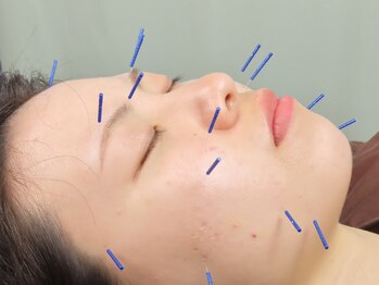 梅沢鍼灸院/美容鍼