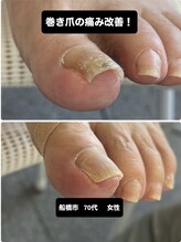 巻き爪じゅん 船橋店/船橋市で巻き爪の痛みを改善