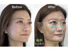 ラプリ 横浜店(Raplit)/隆鼻＋輪郭矯正40分10回