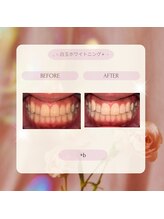 プラスビー 2号店(+b)/ホワイトニングビフォーアフター
