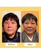 クローバー(clover)/【before/after】施術１回目翌日