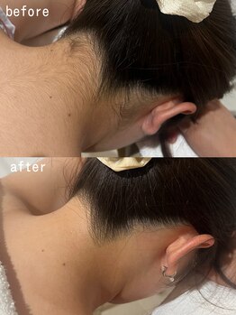 スパ ナナプラス(SPA nana+)/うなじ脱毛