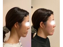 小顔22 ボルティ 本店(Bolty)/【面長】が大きく変化（6ヶ月）