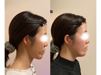 小顔22 ボルティ 本店(Bolty)/【面長】が大きく変化（6ヶ月）