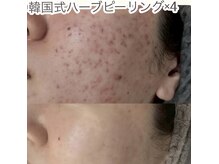 エステサロン ソワンの雰囲気（ハーブピーリング4回施術の変化。ニキビが劇的に綺麗に。）