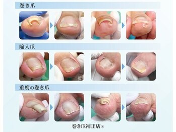 巻き爪補正店 西船橋店の写真/痛みから解放！巻き爪特化サロンで夏に向けて♪美爪ケアで自信あふれる指先に！(巻き爪補正店　西船橋店)