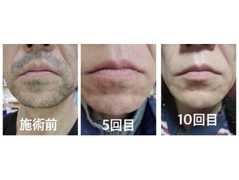 ミライト(MILAIGHT)/髭脱毛１０回