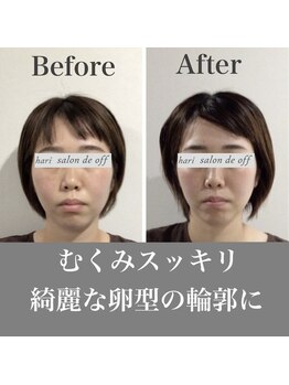 ハリサロンドオフ 心斎橋店(hari salon de off)/むくみスッキリ