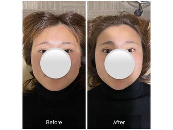 ナオル整体 宮崎院(NAORU整体)/20代女性施術事例【小顔矯正】