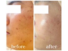 ルー ハナレ 神戸岡本 摂津本山店(Luu HANARE)/３ヶ月小顔たるみ改善・毛穴改善