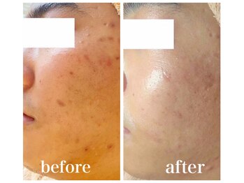 ルー ハナレ 神戸岡本 摂津本山店(Luu HANARE)/３ヶ月小顔たるみ改善・毛穴改善