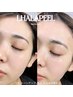 [OPEN記念]ララピール(全顔)韓国発のピーリング施術 ￥7,500