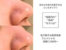 アンシャンテ 神戸元町店(Enchante)/肌質改善ピーリングフェイシャル