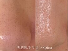 スピカ(SPICA)/一回でこんなに綺麗に