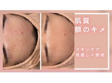 シャルナ(charna)/肌質の変化